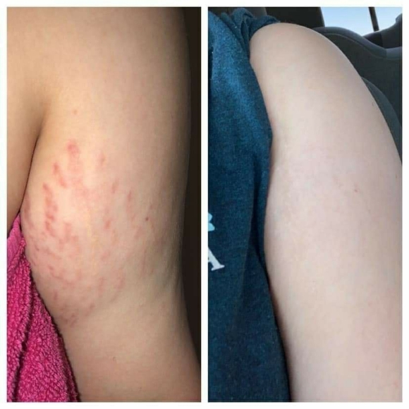 PREORDER ONLY ByeBye Stretch Marks,Mosquitos,Burns - Picture 9 of 16